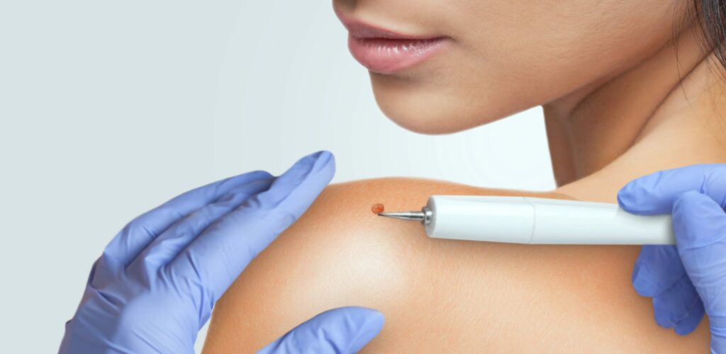 Hautneubildungen entfernen CO2-Laser DermaV Fellbach
